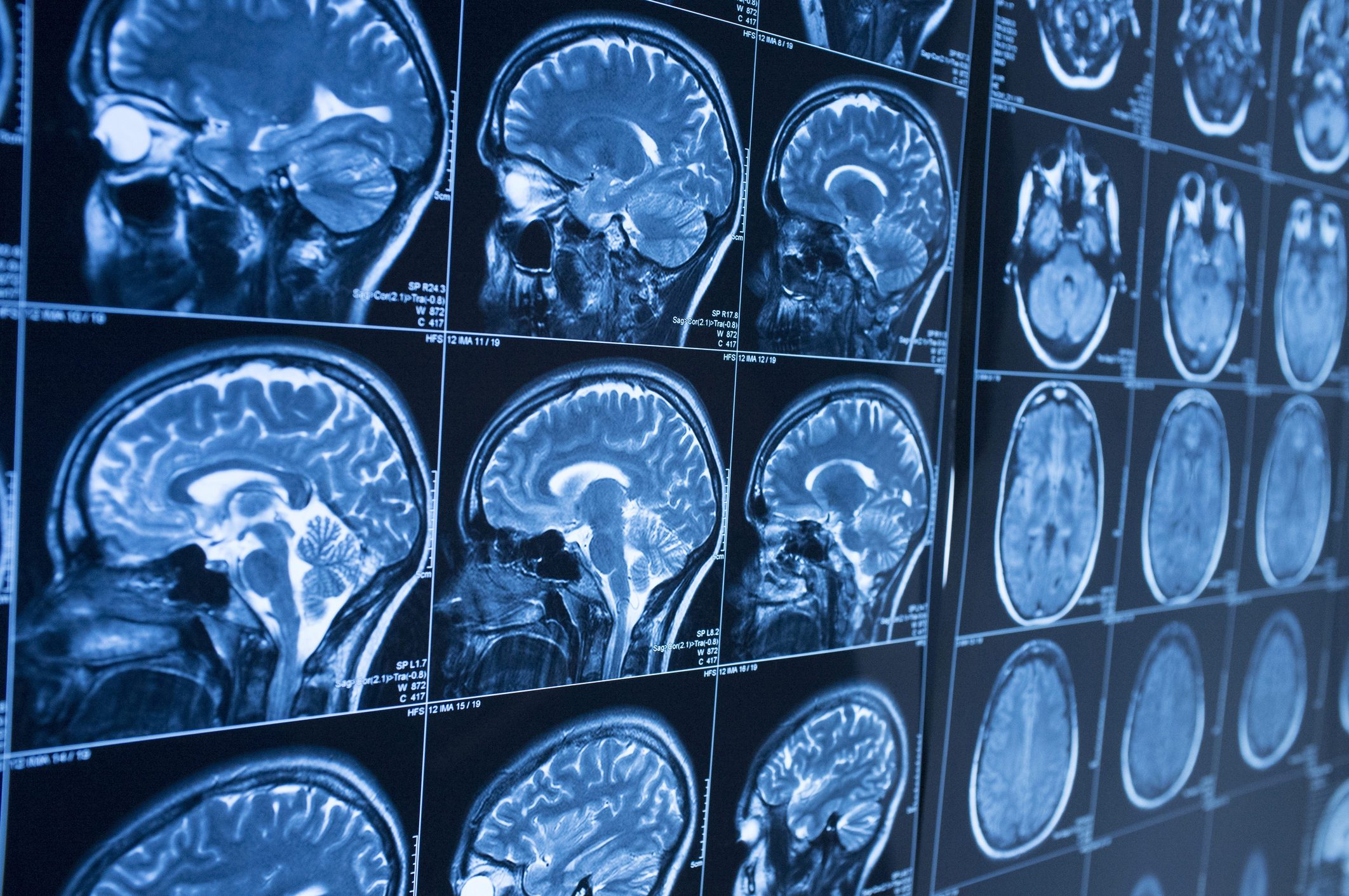 Brain MRI scans showing side and top views, displaying detailed images of brain structures in various sections.